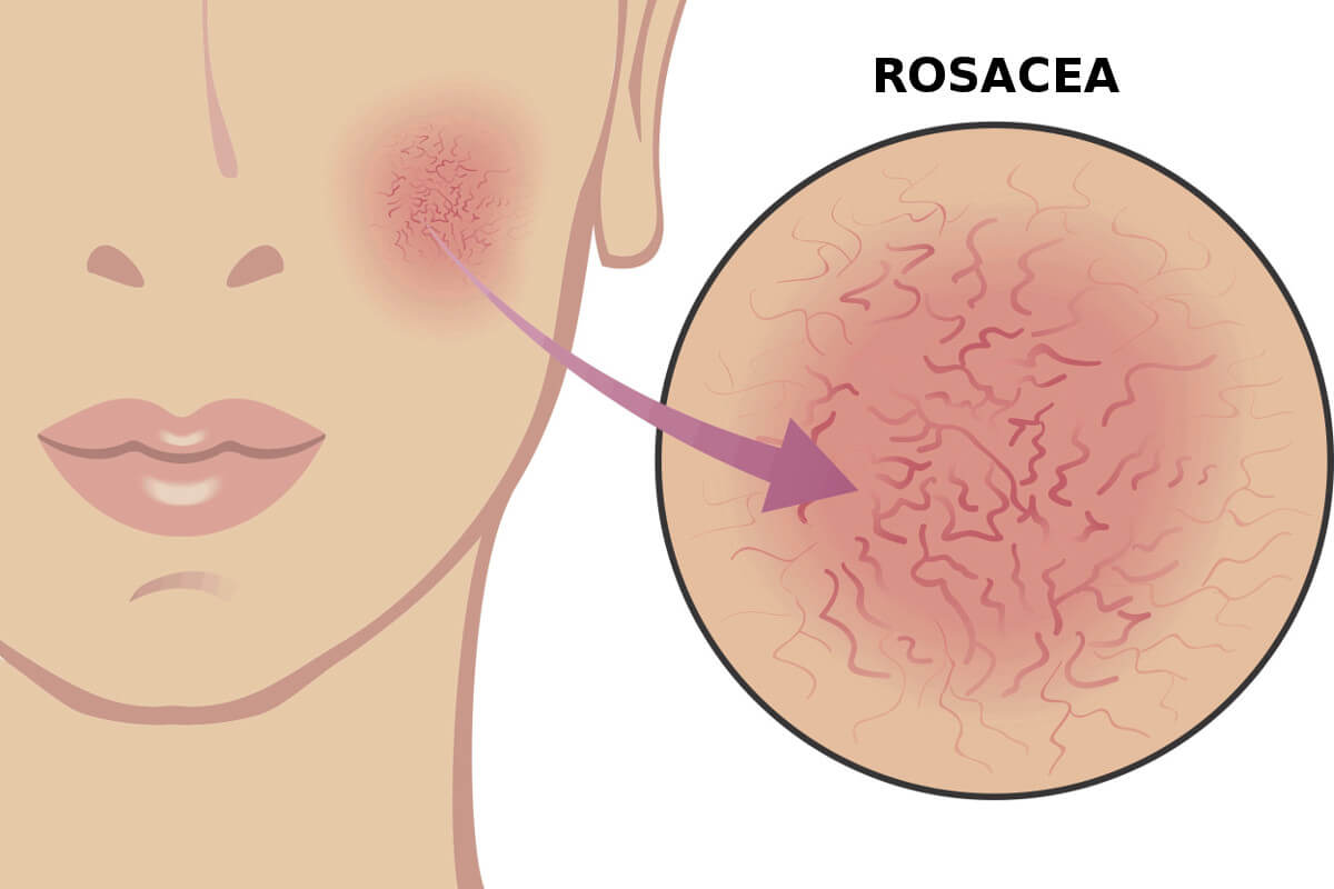 What Is Rosacea And How Do You Treat It